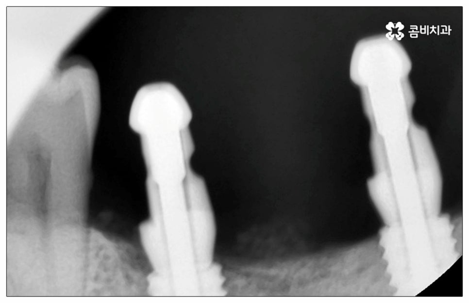 건강보험임플란트 혜택받아 보세요 관련 이미지 7