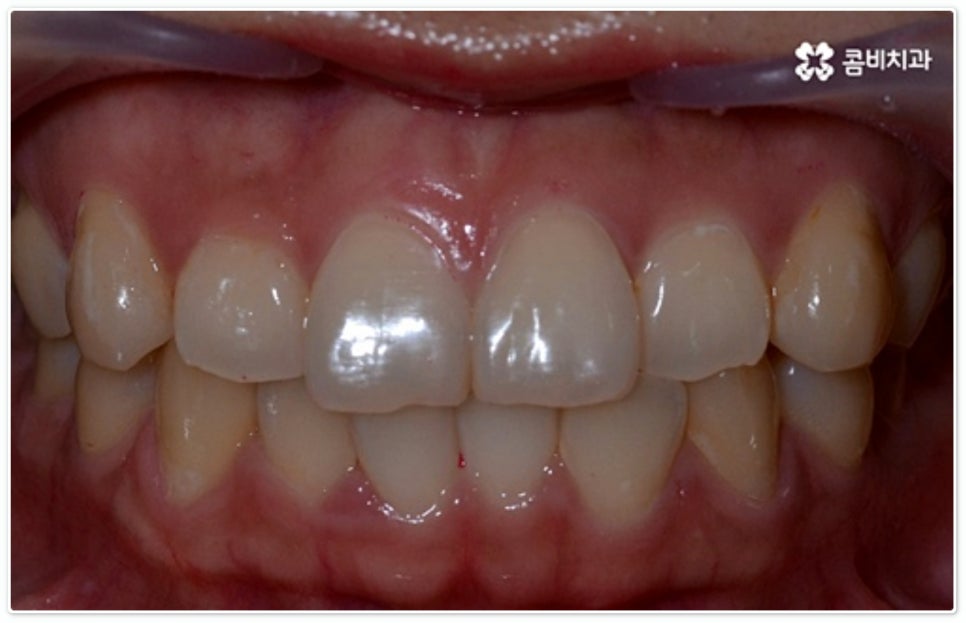 앞니부분교정 누구나 할수있나요? 관련 이미지 3
