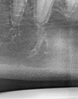 어금니 뒤 잇몸 부음 어떤 문제길래 이런거죠 관련 이미지 42