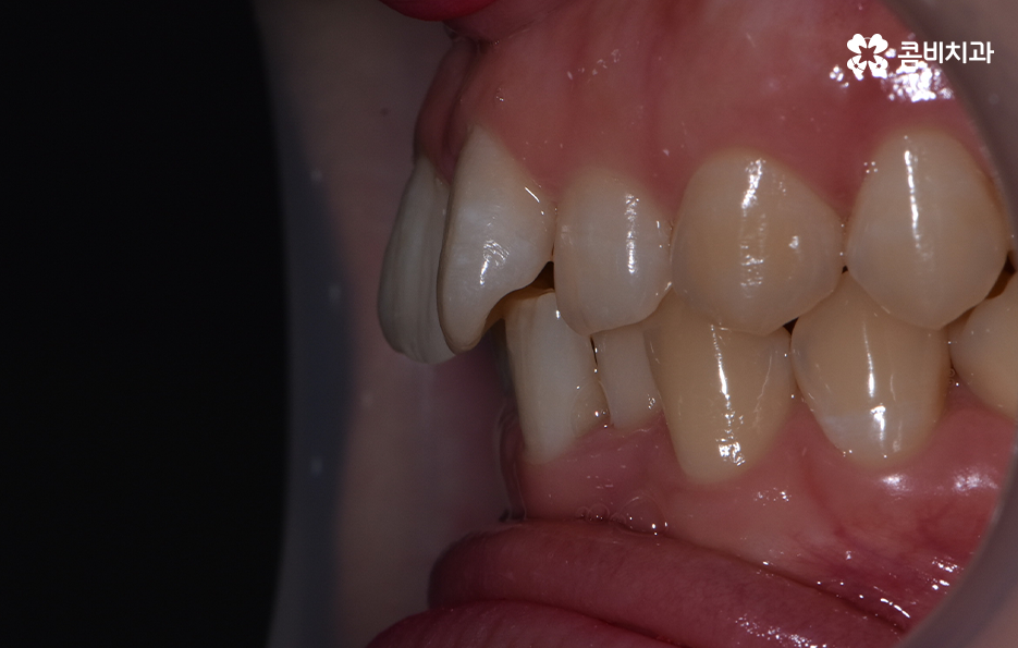 앞니 틀어짐 교정으로 해결하면 될까요 관련 이미지 4