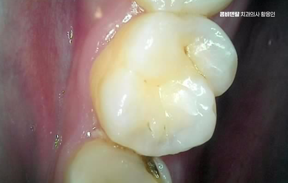 사랑니 발치 후 충치 치료 둘다 준비하려면 관련 이미지 2