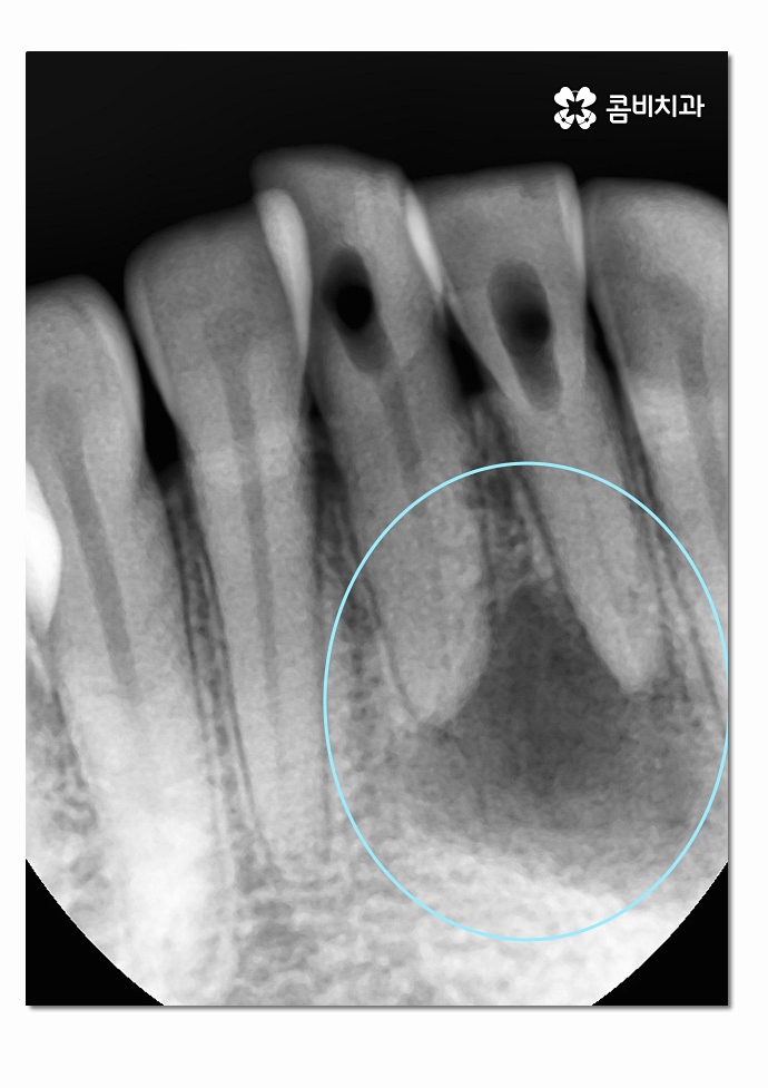치주염으로 인한 아랫니 임플란트 절차를 알아보면 관련 이미지 3