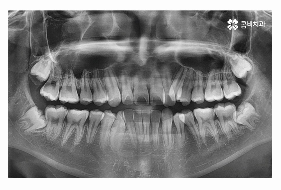 덧니 발치 필수적으로 하는건가요 관련 이미지 4