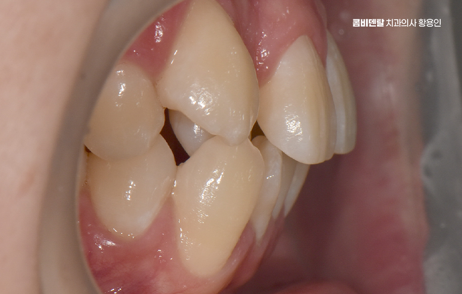 송곳니 덧니 발치 이럴때 해당되네요 관련 이미지 3