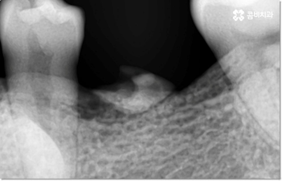 아랫니임플란트 주의할것들은? 관련 이미지 2