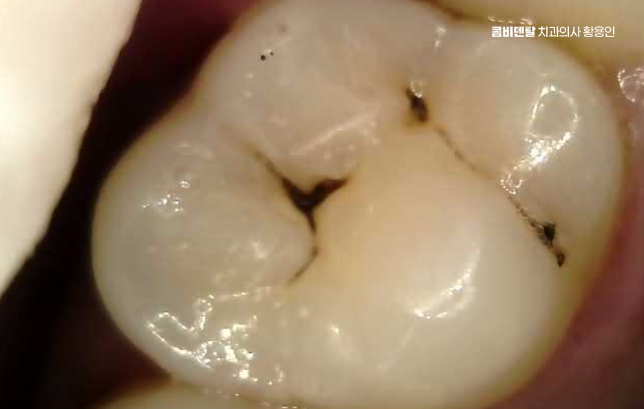 충치 치아 깨짐 시점이 관건이라면 관련 이미지 9