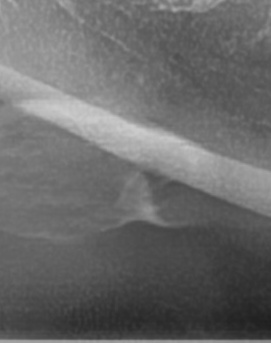 어금니 뒤 잇몸 부음 어떤 문제길래 이런거죠 관련 이미지 40