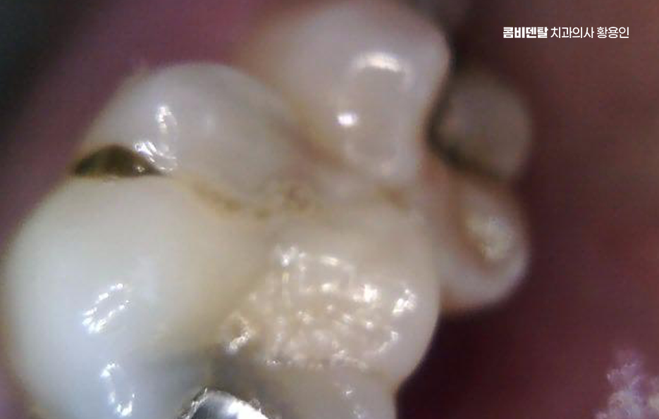 Be Careful Not to Delay Treatment for Cavities Between Your Teeth image 4