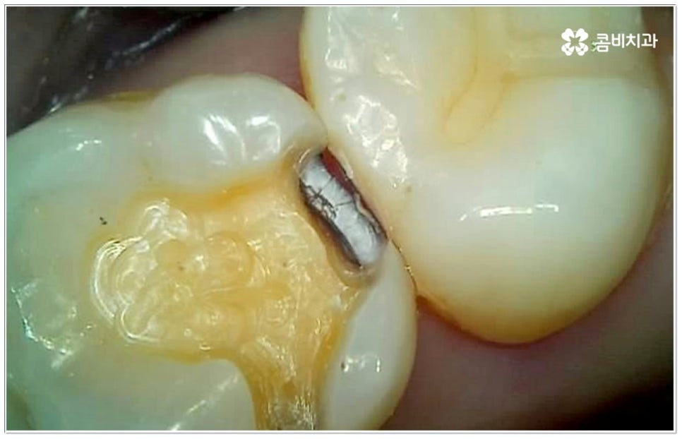 충치 인레이 언제 받나요? 관련 이미지 1