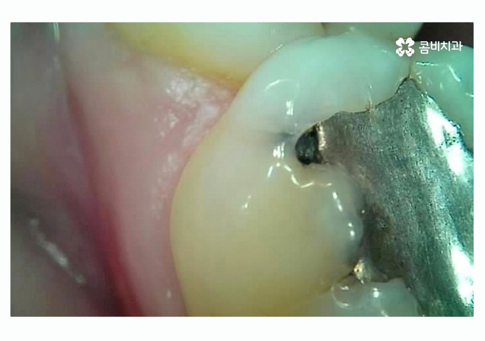 충치 떼우기 스무살이후에 조심해야 할 점은? 관련 이미지 2