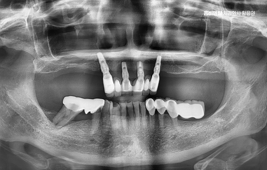 어금니 임플란트 뼈이식 이럴때 해당됩니다 관련 이미지 2