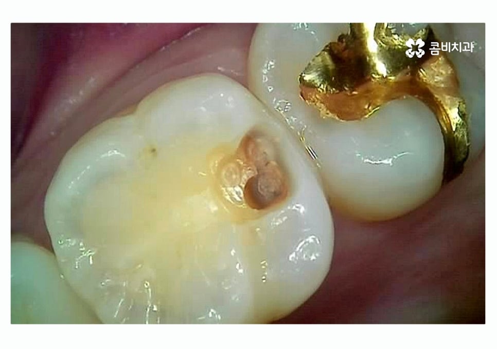 충치 떼우기 스무살이후에 조심해야 할 점은? 관련 이미지 7