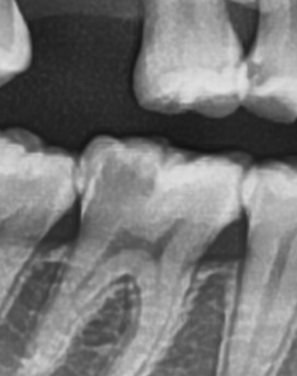 어금니 뒤 잇몸 부음 어떤 문제길래 이런거죠 관련 이미지 31