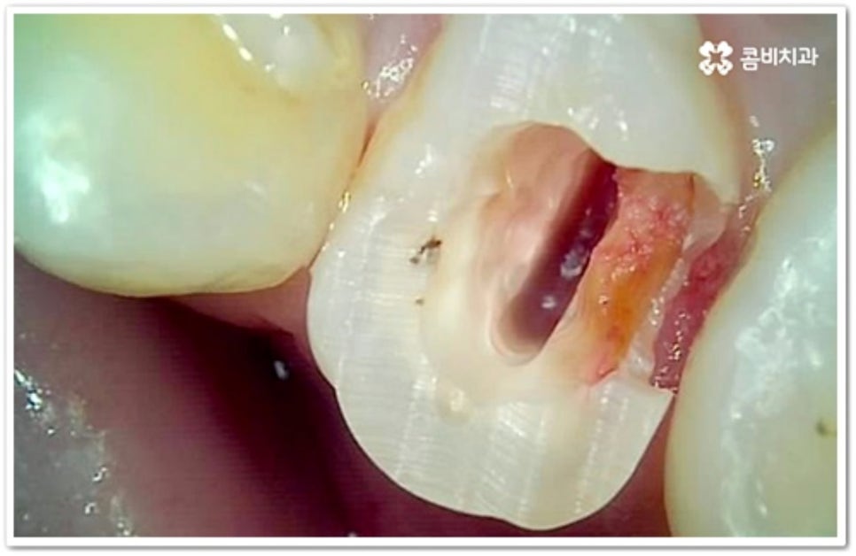인접면 충치 어떻게 하나요 관련 이미지 6
