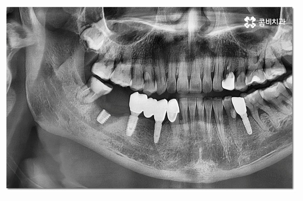 어금니임플란트 합리적으로 알아보려면 관련 이미지 5
