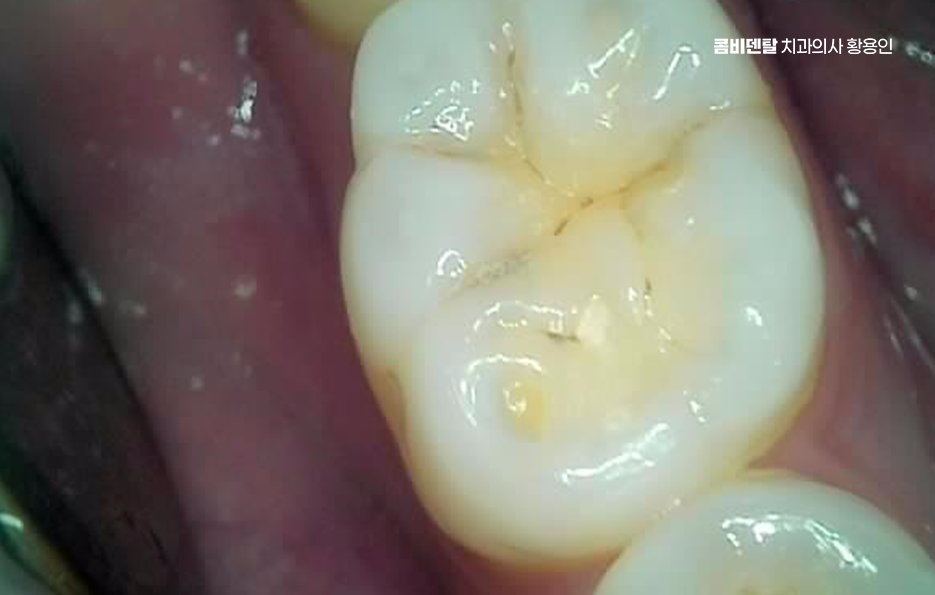 명동치과 흔하게 놓치는 사례를 정리해요 관련 이미지 6