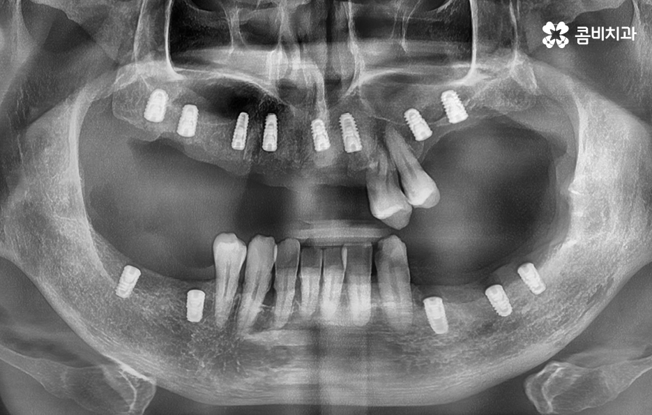 65세이상 임플란트 개수 구체적으로 체크하려면 관련 이미지 9