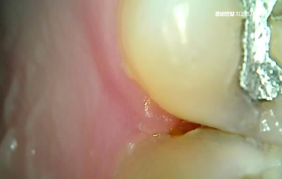 아말감 교체 레진 인레이 어떻게 대처하면 될까 관련 이미지 2