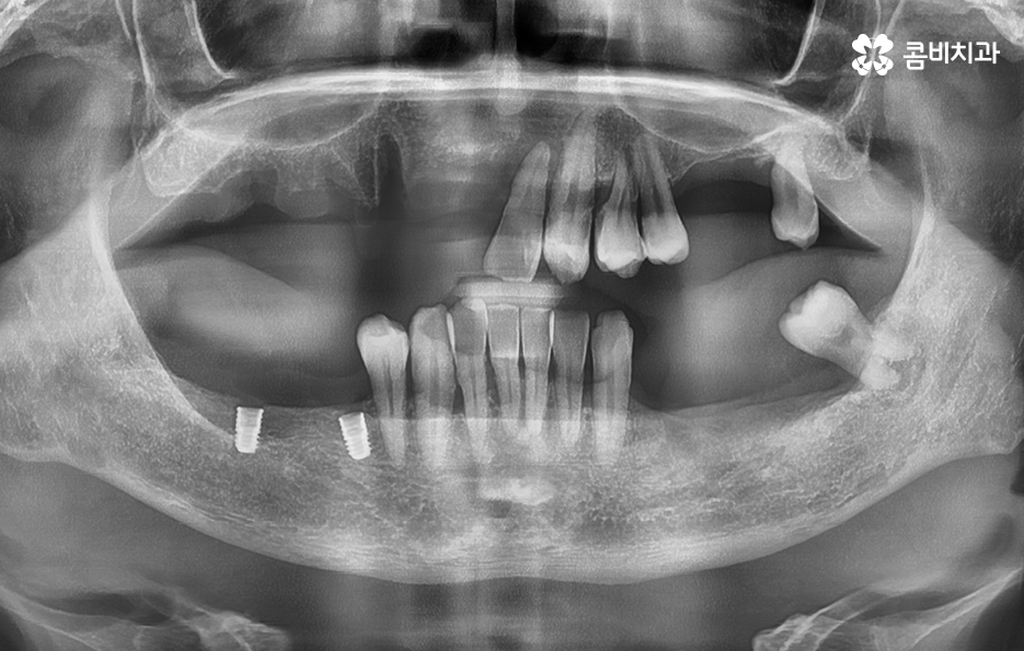 65세이상 임플란트 개수 구체적으로 체크하려면 관련 이미지 5