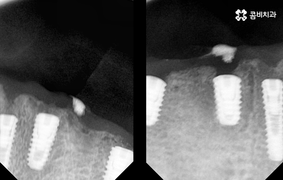 전체임플란트 어떤 방식으로 해야하나요 관련 이미지 5