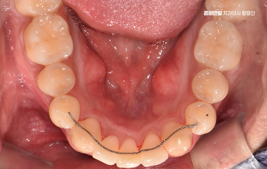 Can Crooked Lower Teeth Be Improved Without Extraction? image 10