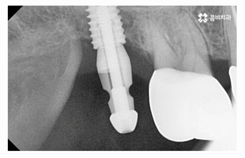 임플란트수술 제대로 알고 선택하려면 관련 이미지 7