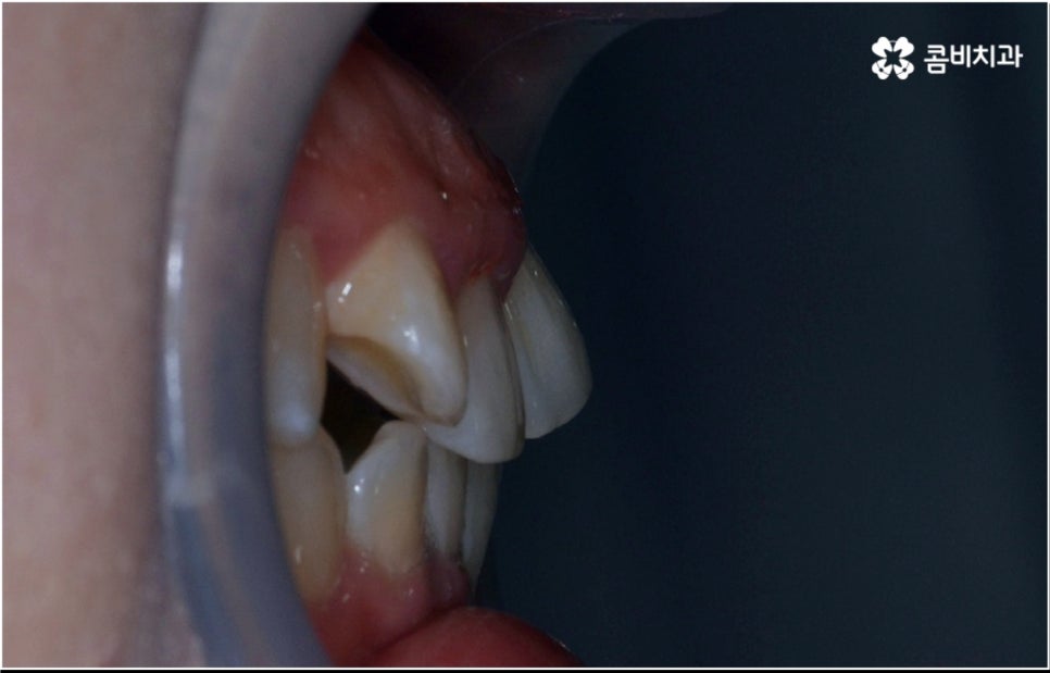 성인 치아교정 기간 걱정이 앞서나요 관련 이미지 4