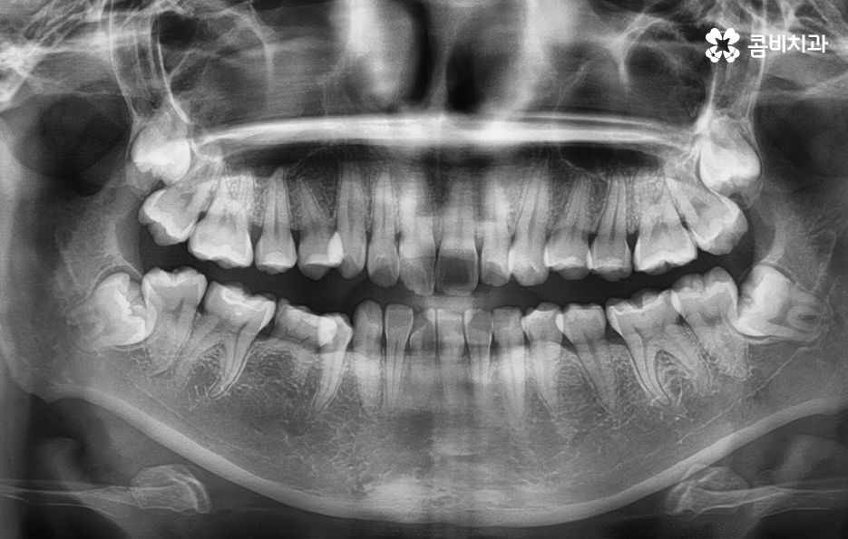 덧니 발치 교정 이런 경우에는 필요합니다 관련 이미지 1