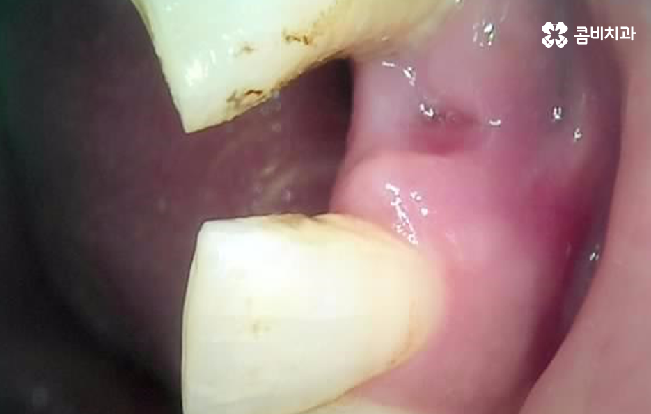 치아 옆면 충치 이렇게 무섭습니다 관련 이미지 4