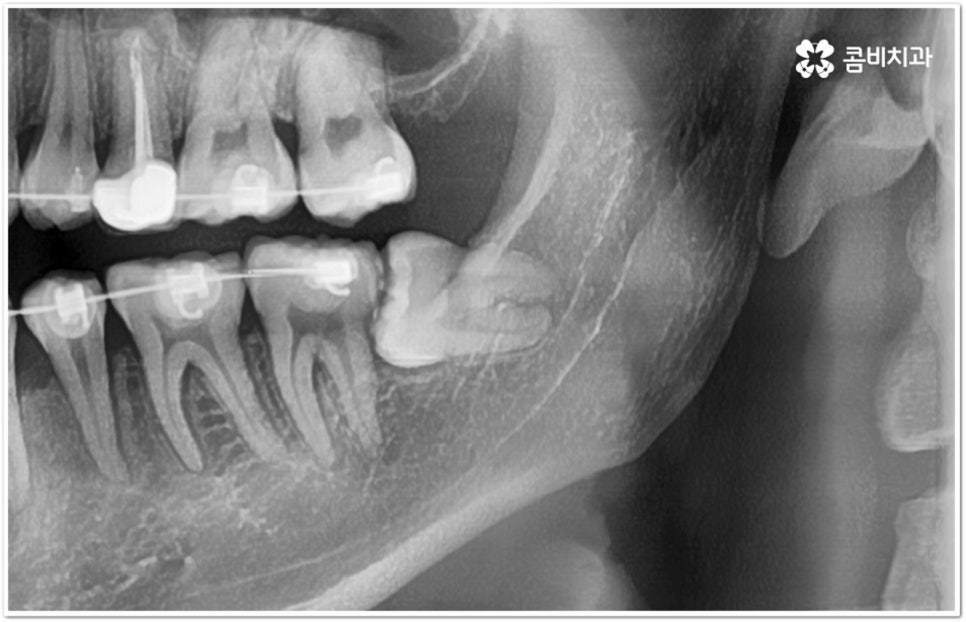 아래사랑니발치 망설이고 있다면 관련 이미지 11