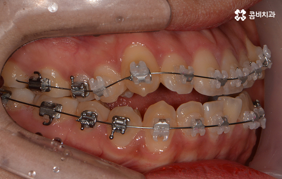 송곳니 덧니 뽑지 않고 해결된 사례 관련 이미지 11