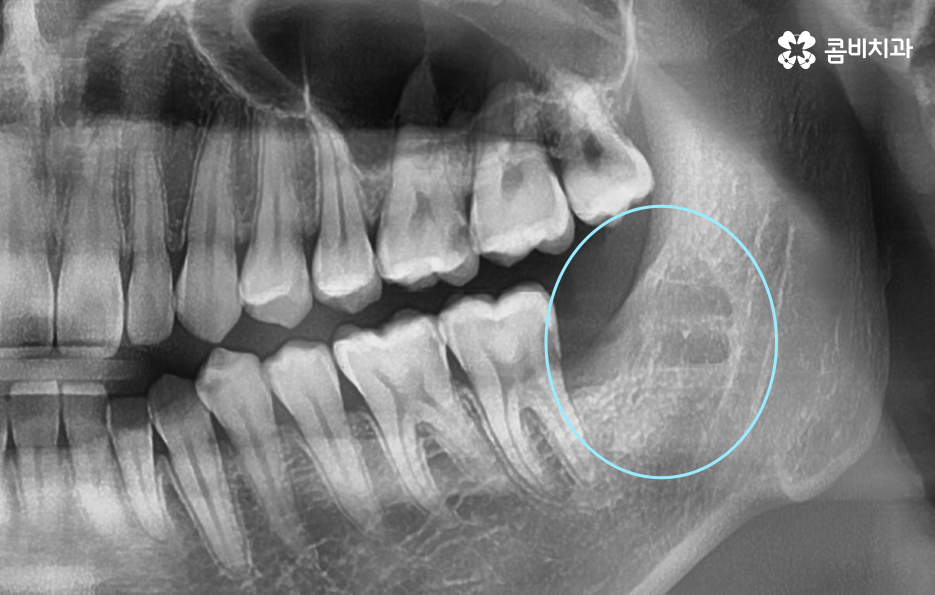 부분매복 사랑니 발치 신중하게 대비하려면 관련 이미지 4