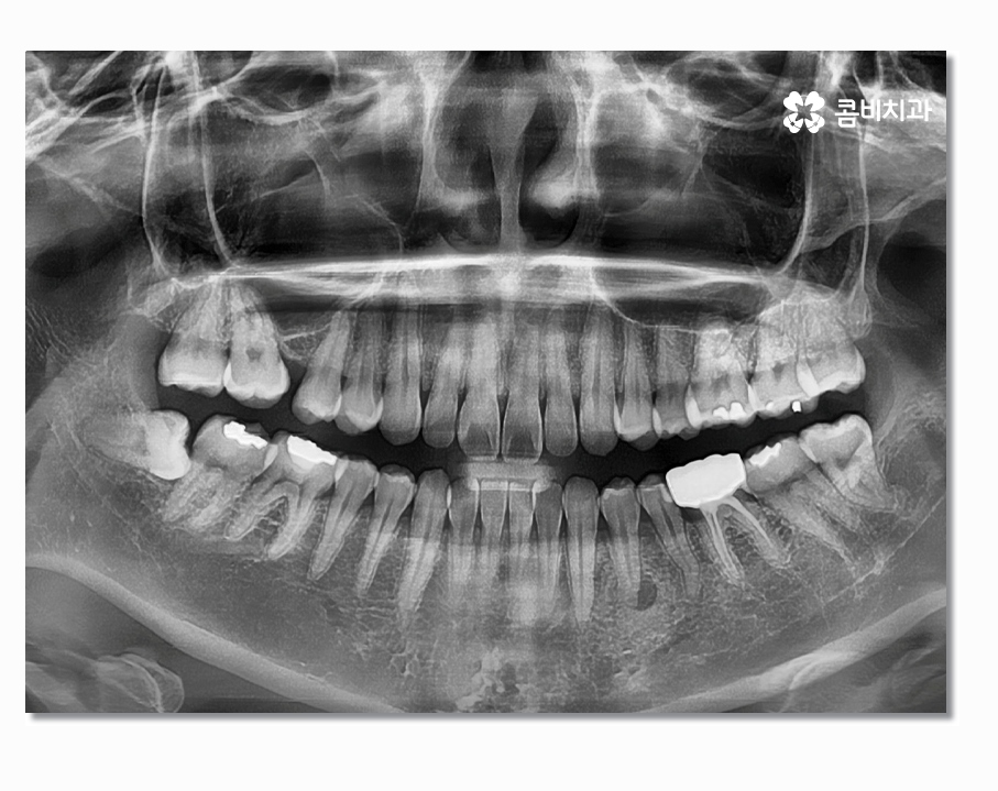부분매복사랑니 언제 뽑아야 할까 관련 이미지 1