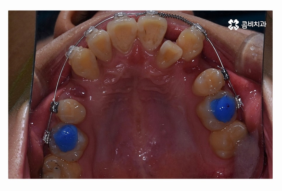 덧니 발치 필수적으로 하는건가요 관련 이미지 10