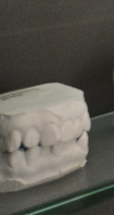 완전매복사랑니 발치 대학병원 꼭 가야하나요 관련 이미지 39