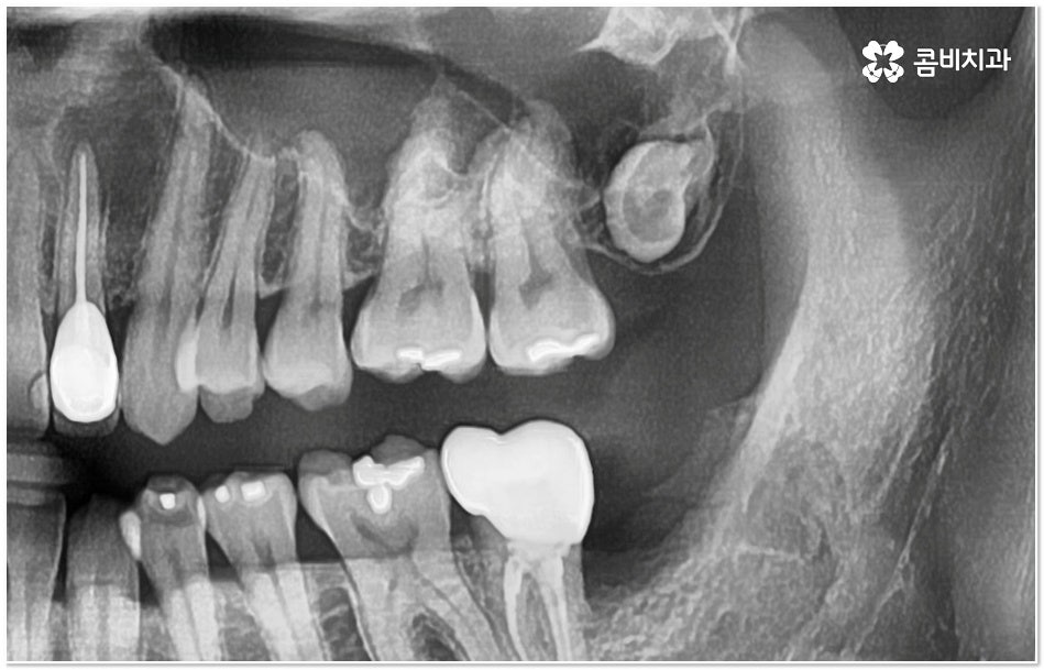 치아 사이 충치 어떻게 하나요 관련 이미지 6