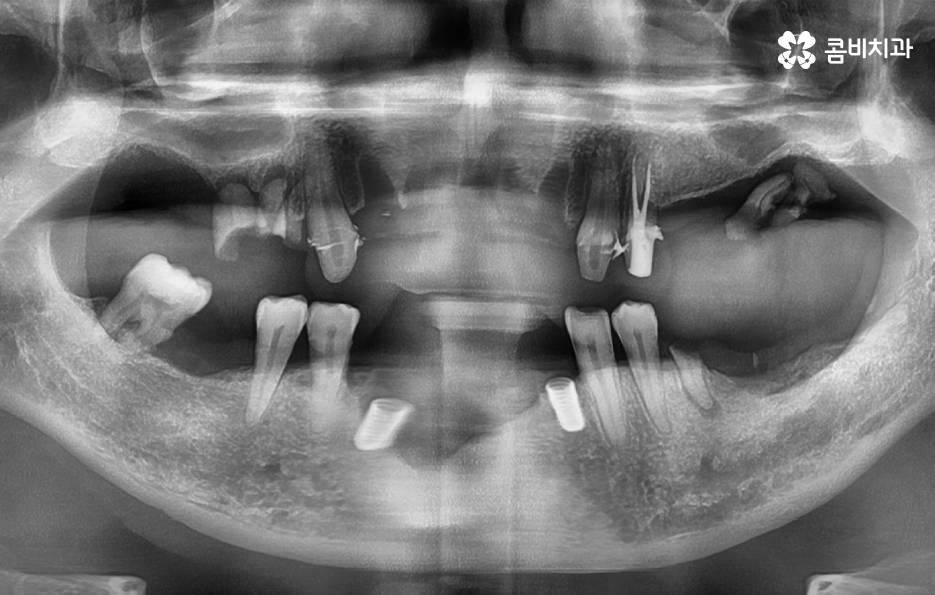 치주염 발치 이렇게나 심각하네요 관련 이미지 9