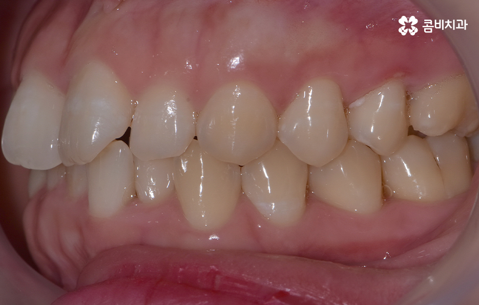 앞니 틀어짐 교정으로 해결하면 될까요 관련 이미지 3