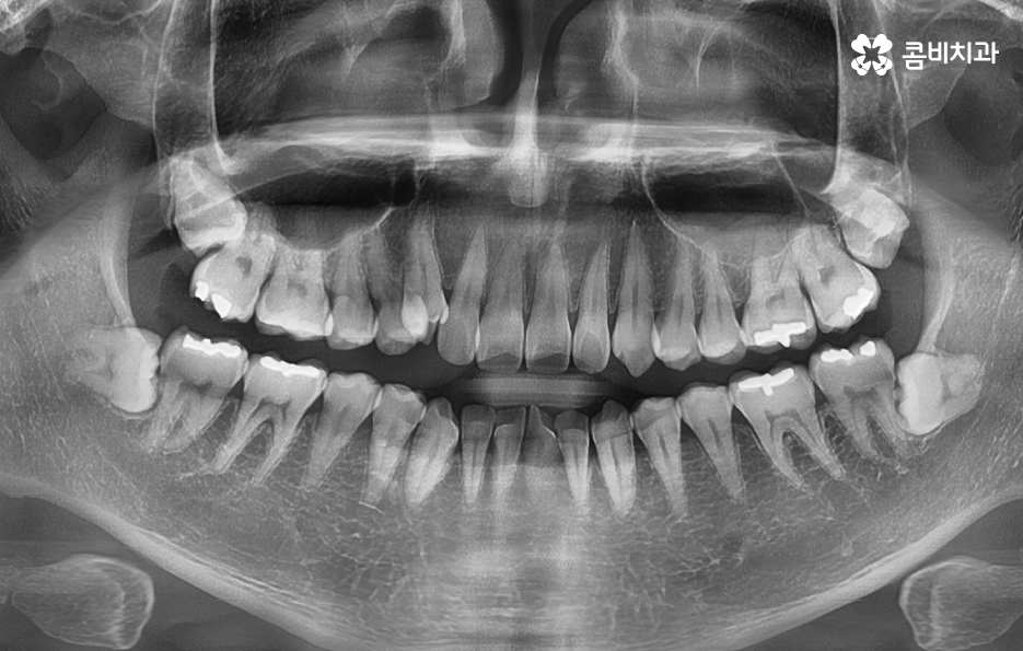 어금니 충치치료 깔끔하게 해결하려면 관련 이미지 1