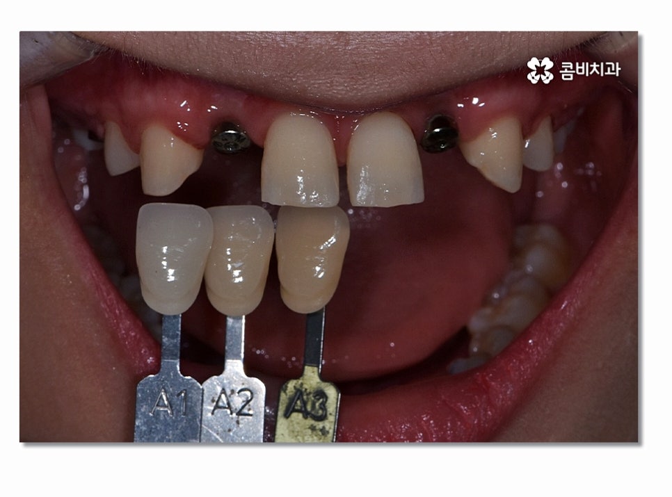 앞니임플란트 합리적으로 접근하려면 관련 이미지 6