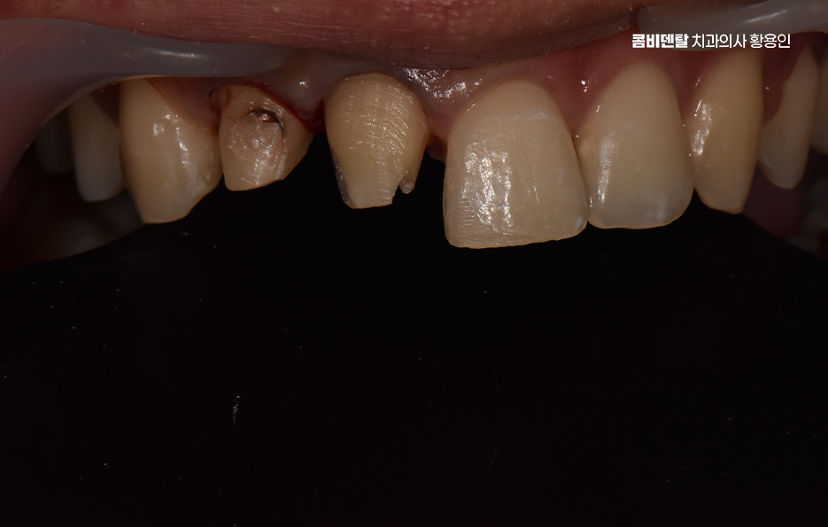 깨진 앞니 크라운 어떻게 해야 깔끔하게 해결될까 관련 이미지 4