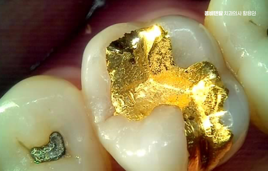 인레이 치료 후 신경치료 이유가 궁금하다면 관련 이미지 8