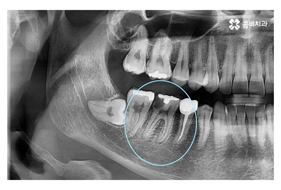 신경치료 후 크라운 시기를 놓치지 않으려면 관련 이미지 3