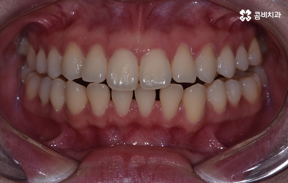 아래앞니 벌어짐 교정으로 해결했어요 관련 이미지 1