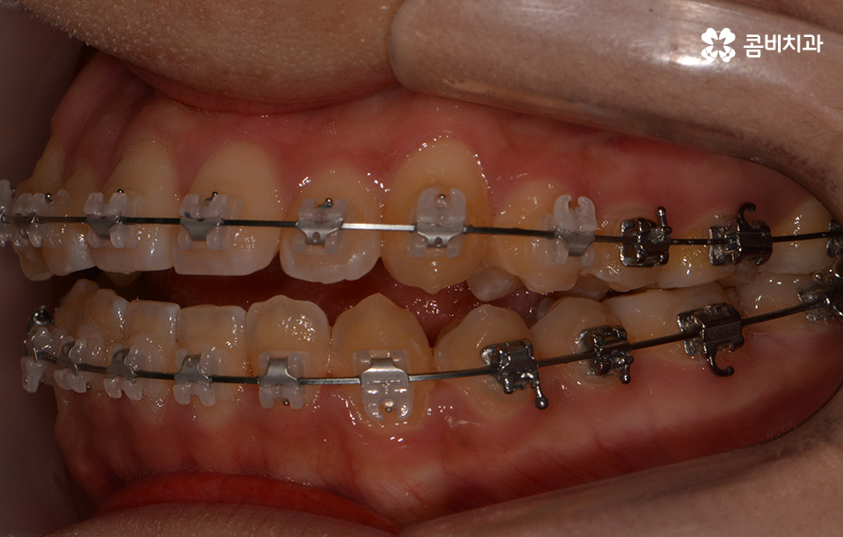 송곳니 덧니 뽑지 않고 해결된 사례 관련 이미지 13