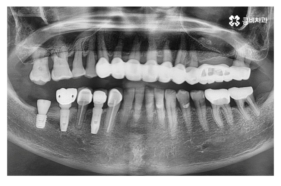 임플란트 기간 케이스에 따라 달라진다면 관련 이미지 5