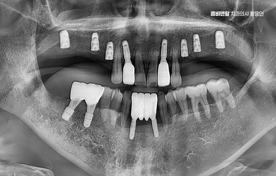 50대임플란트 꼼꼼하게 따져봐야할 포인트는 관련 이미지 7