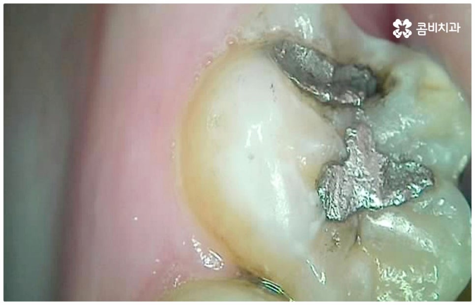 어금니충치치료 아프다면 빨리 관련 이미지 2