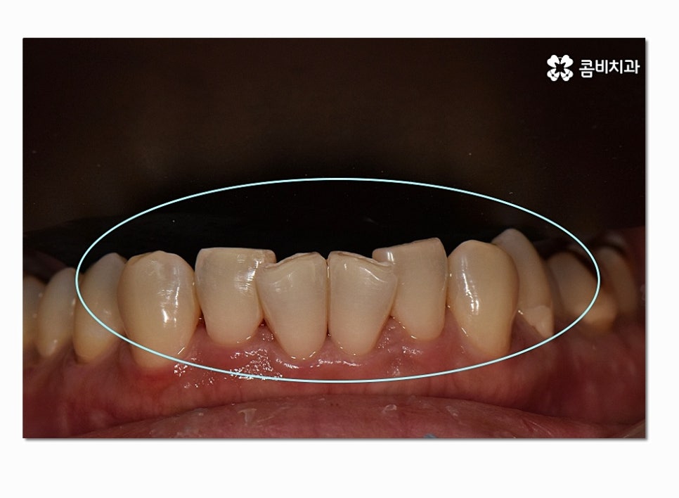 치아라미네이트 누구에게 필요할지 궁금하다면 관련 이미지 8