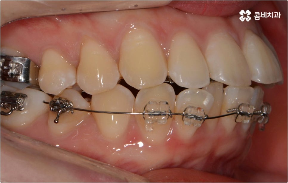 돌출입 치아교정 부모와 아이가 함께 알아봐요 관련 이미지 2